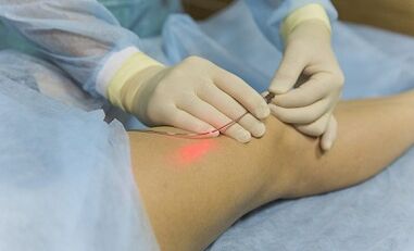 Liječenje varikoznih vena laserom
