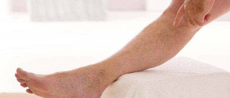 Varikozne vene na nogama